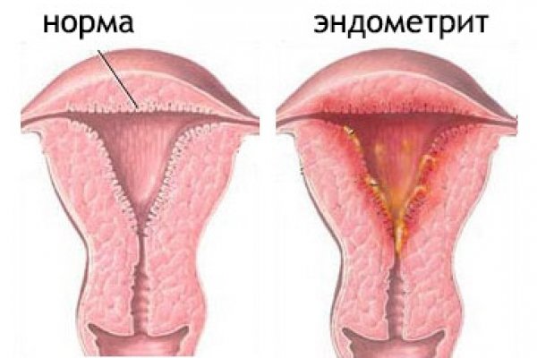 Эндометрит