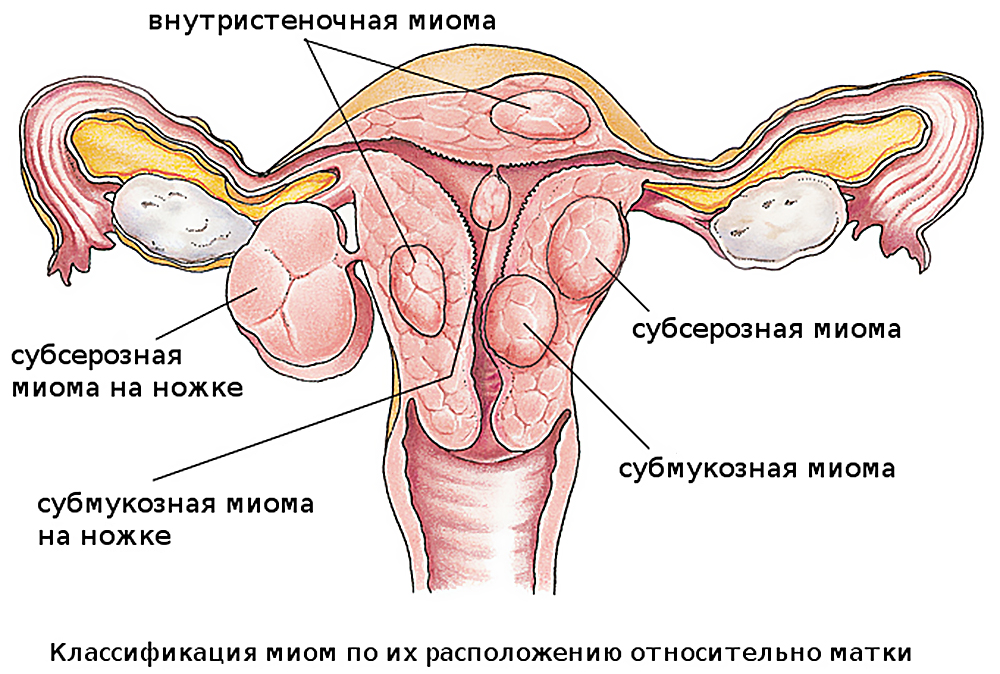 Миома